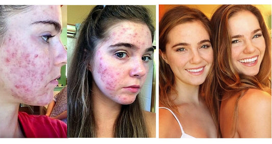 How We Cured Cystic Acne With One Simple Diet Change