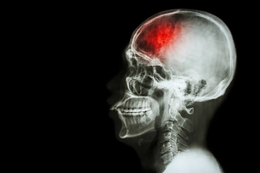 How to Prevent a Stroke