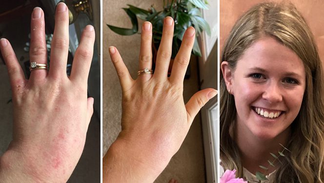 On a Plant-Based Diet, I’m Finally Finding Relief from Severe Eczema