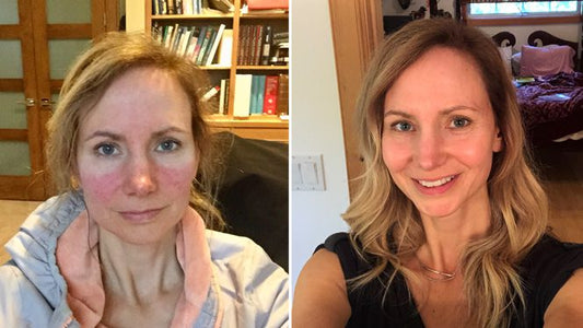 A Healthy Vegan Diet Took Me from Rosacea-Prone to Radiant